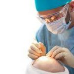 Successful Hair Transplant Procedures in the UK