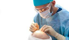 Successful Hair Transplant Procedures in the UK