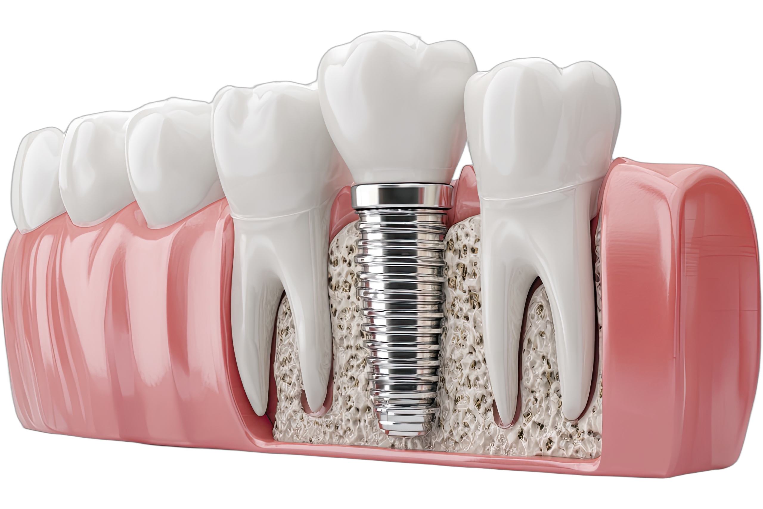 Oral Tourism – The Best Countries To Find Dental Implants