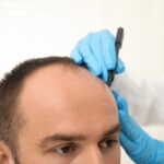 Hair Transplant Turkey - Where To Start