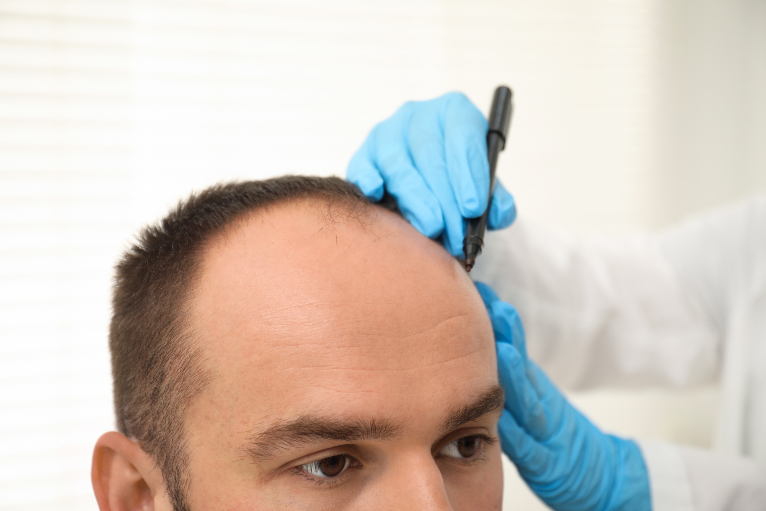 Hair Transplant Turkey – Where To Start?