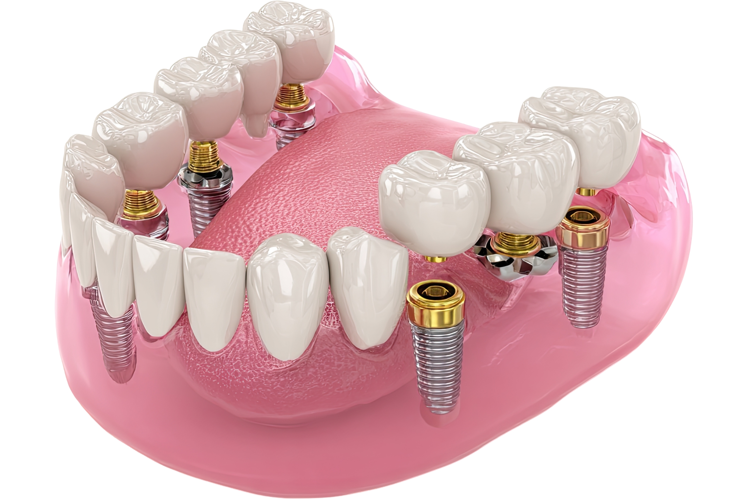 What Are The Cheapest Countries To Have Dental Implants Overseas In 2023?