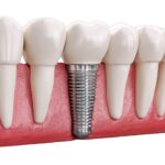 A Guide To Getting Dental Implants Abroad